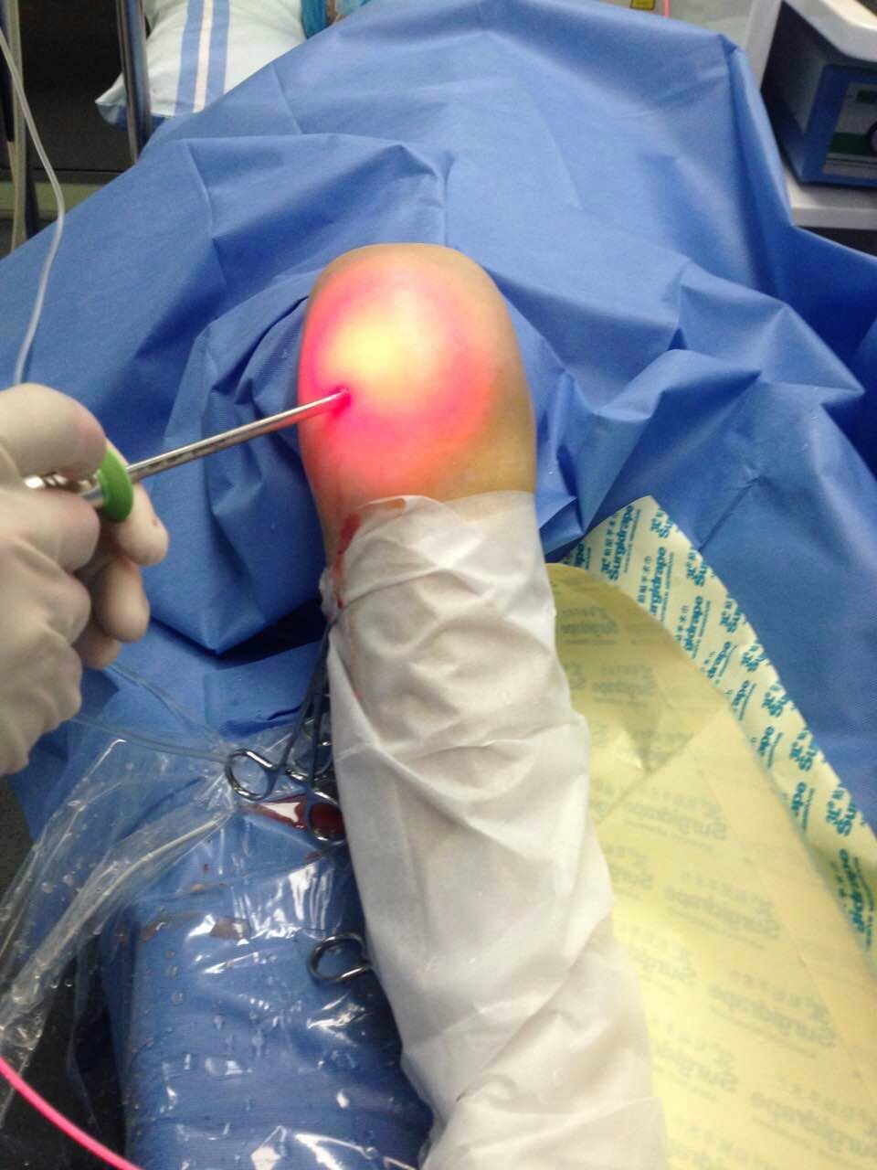 微创针刀镜 光动力治疗微创针刀镜下所见关节滑膜大量增生呈绒毛状